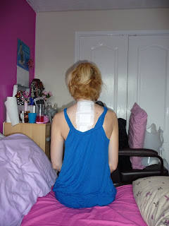 2 weeks after scoliosis surgery with a dressing on my scar