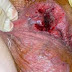Obat Herbal Ambeclear Ampuh Mengobati Wasir Dalam thumbnail