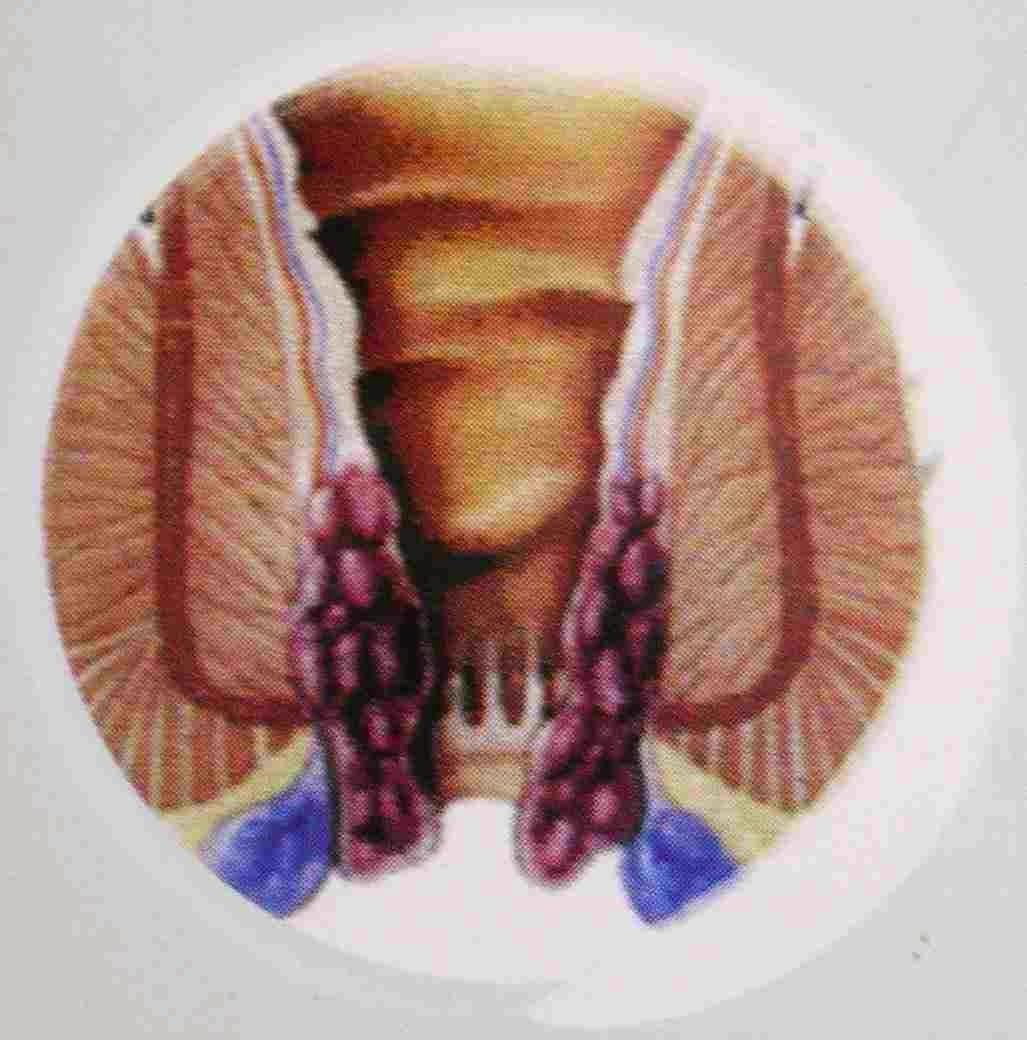 Image Obat Wasir Ampuh Bagus