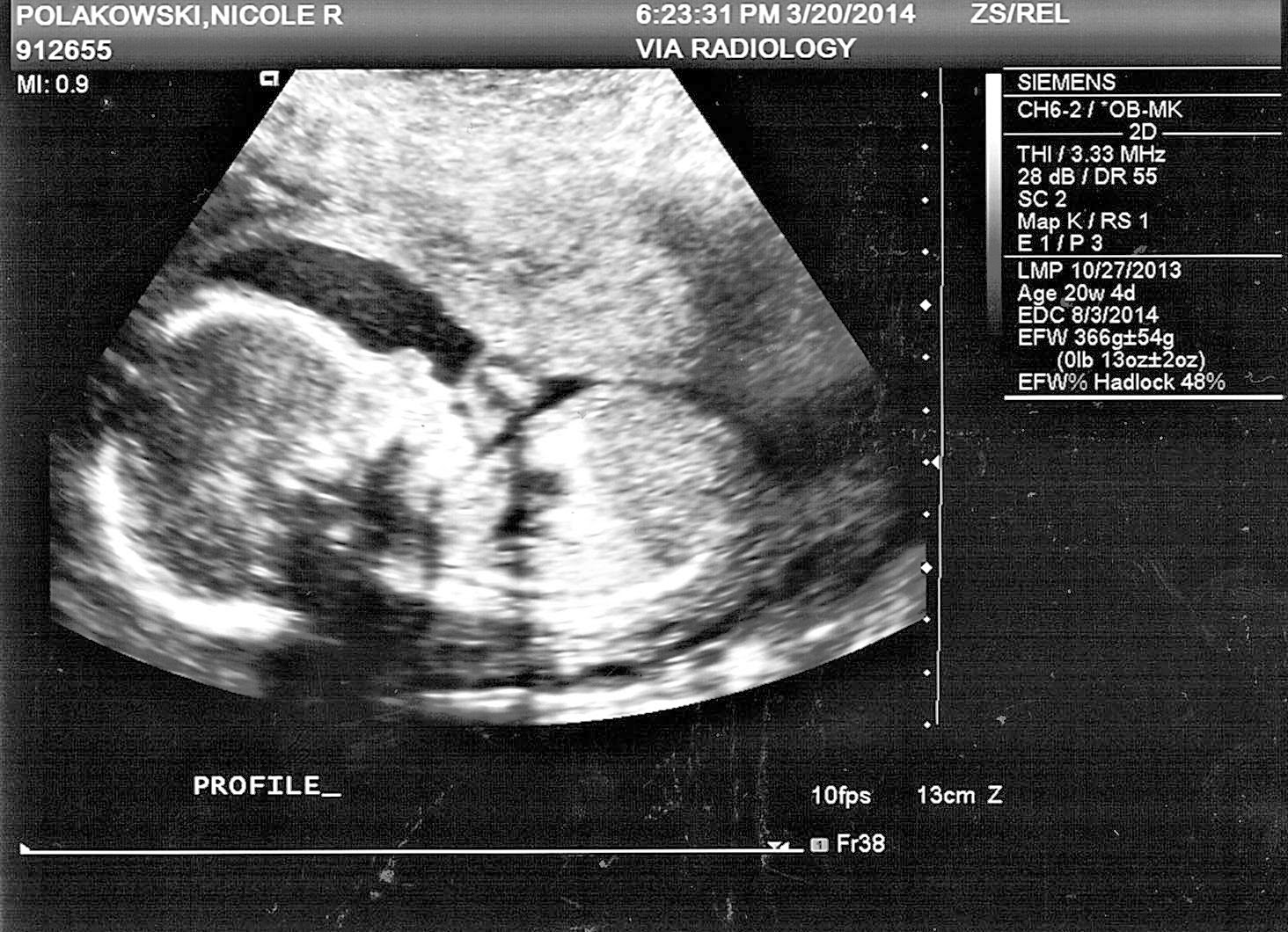 20 Week Anatomy Ultrasound