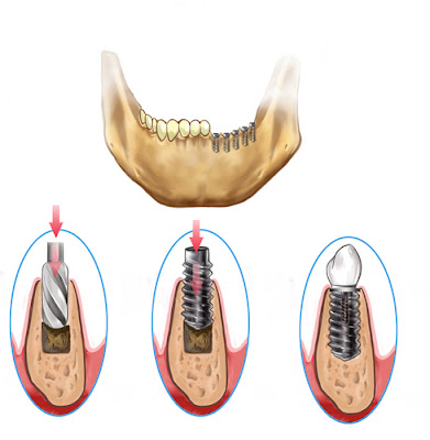 Cylindrical implants Cylindrical implants