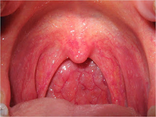 Những triệu chứng thường gặp ở bệnh viêm họng