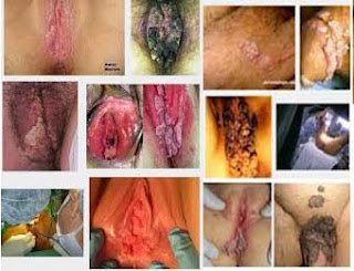 Cara Menghilangkan Kutil yang Muncul di Kelamin Cara Menghilangkan Kutil yang Muncul di Kelamin