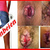 Di Bandung, Obat Wasir Ambeclear Bisa di Beli dimana? thumbnail