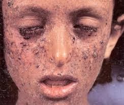 Medical Treatment Pictures For Better Understanding Xeroderma