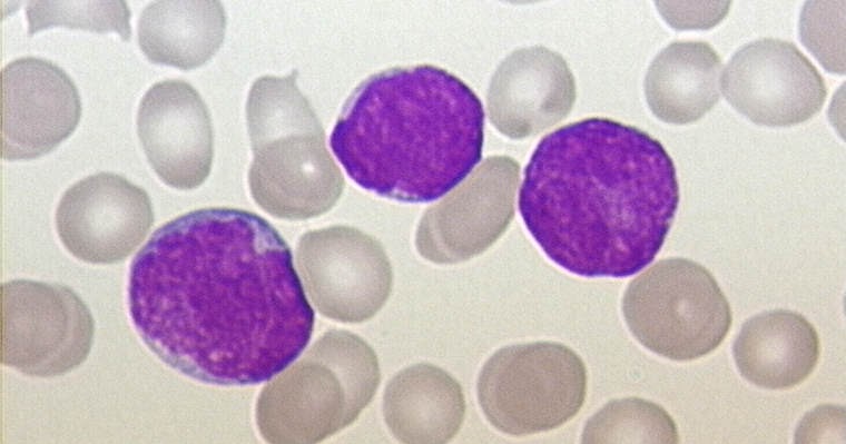 HEALTH FROM TRUSTED SOURCES Acute Lymphoblastic Leukemia