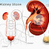 Natural Remedies to Prevent and Treat Kidney Stones