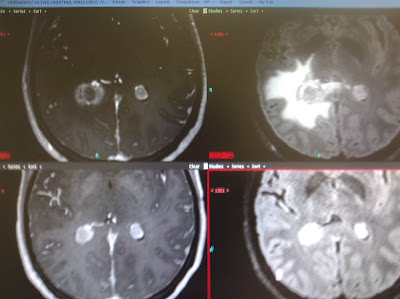 gamma brain knife months introduced last