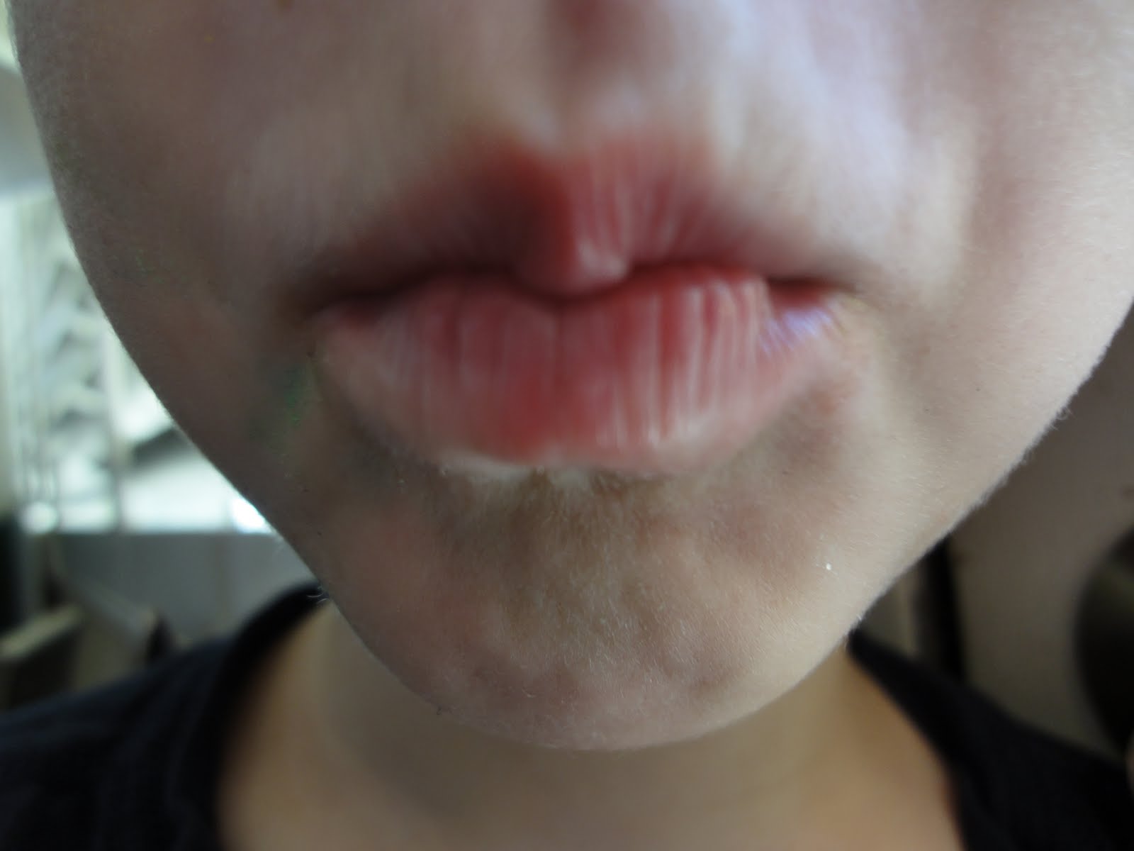 Lips Always Dry