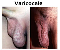 Varicocele
