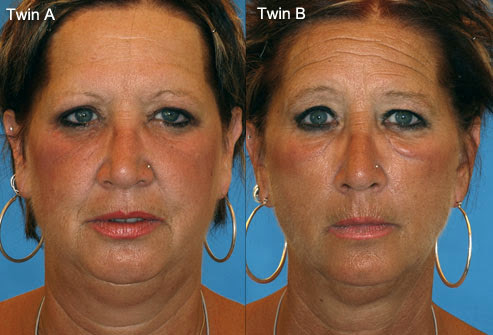 effect od smoking on skin identical twins