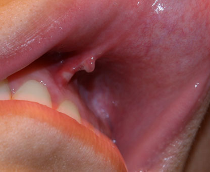 Upper Lip Frenulum