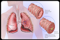 BRONCHITIS BRONCHITIS