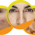 9 Simple Home Remedies for Pimples