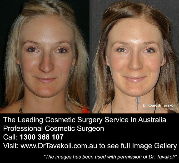 Nose Job Tip Refinement Before and After The Leading Cosmetic Surgery