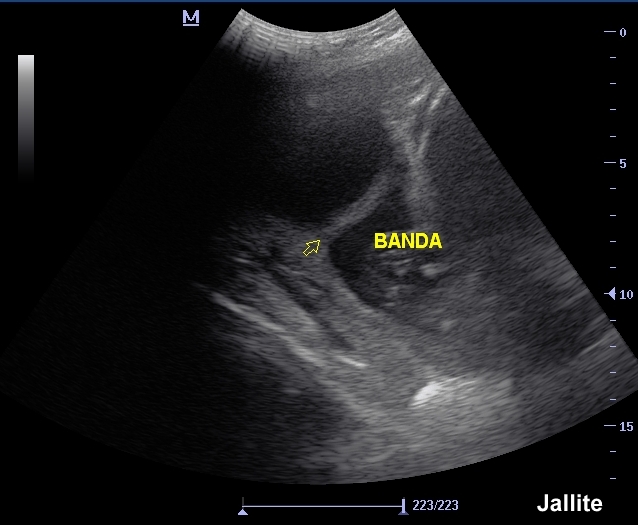 Diario de un Medico II Sinequia Uterina Vs Brida Amniotica