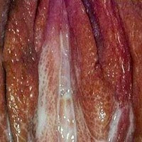 sipilis wanita sipilis wanita