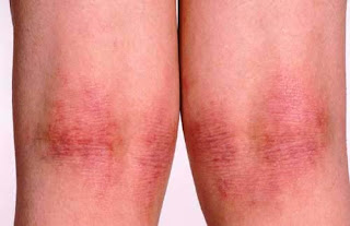Atopic dermatitis.1