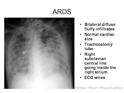 Diabetic foot Identification of Chest X-rays of Common Lung Diseases ~ YOUNG DOCTORS
