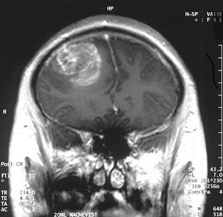 MRI image of a glioblastoma