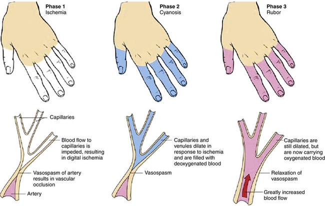 Discussion on this topic: Is There a Heart Disease Gene, is-there-a-heart-disease-gene/ Discussion on this topic: Is There a Heart Disease Gene, is-there-a-heart-disease-gene/