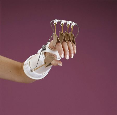 what is a serial static splint what is a serial static splint