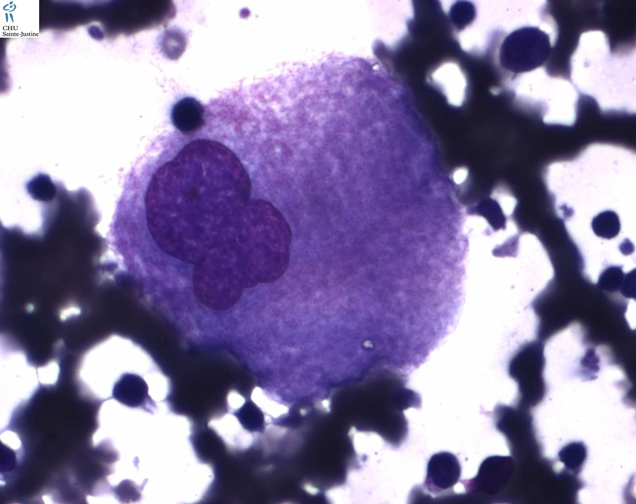 Gaucher disease meddic