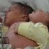Bebê nasce com duas cabeças no Pará