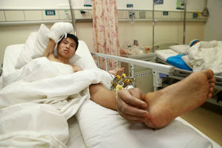 Tangan Ditampal Di Buku Lali Kaki Tangan Ditampal Di Buku Lali Kaki