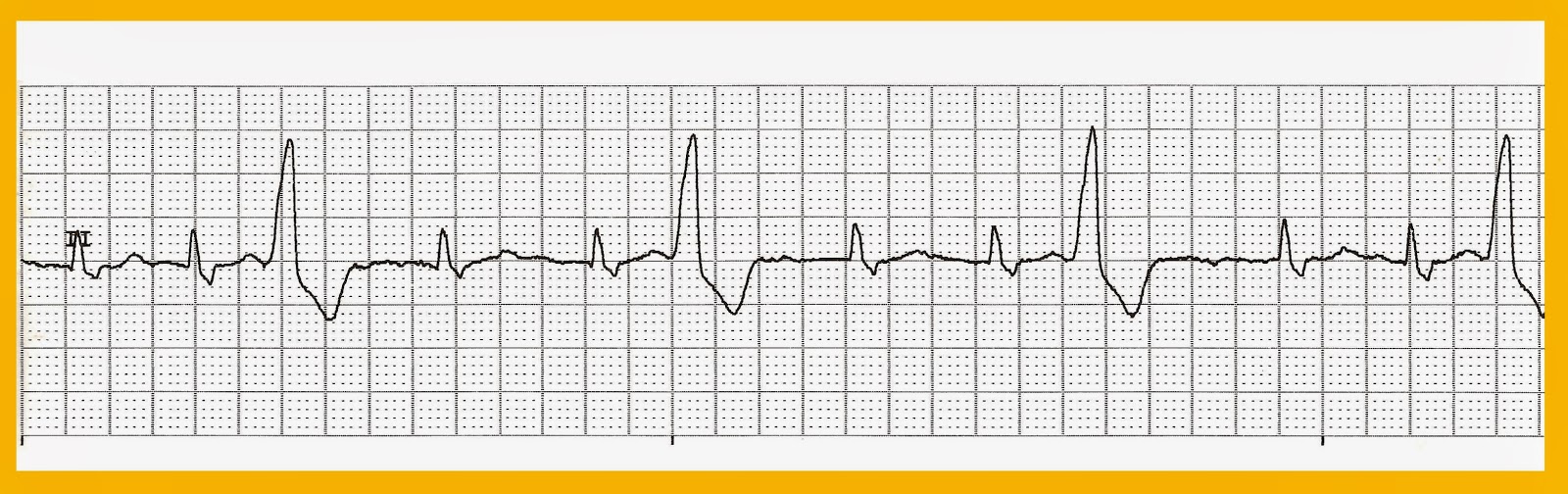 Float Nurse Various Trigeminal PVCs