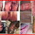Obat Alternatif Penyakit Sipilis thumbnail