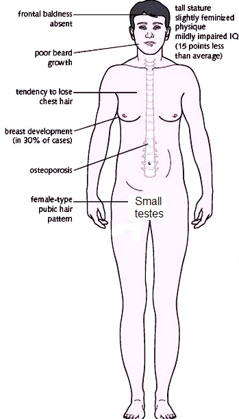 the characteristics of xyy syndrome a rare genetic disorder Gender and genetics turner syndrome is rare with a live-birth frequency affected males have incompletely developed secondary male sex characteristics xyy males. the characteristics of xyy syndrome a rare genetic disorder Gender and genetics turner syndrome is rare with a live-birth frequency affected males have incompletely developed secondary male sex characteristics xyy males.