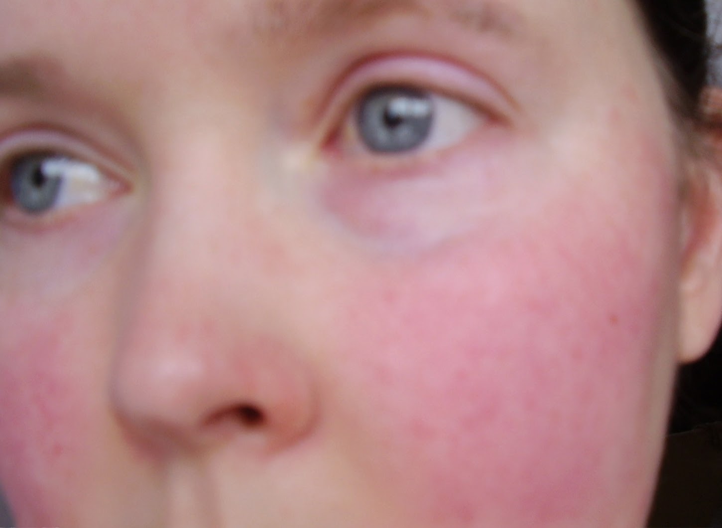 Scarlet Letters, dealing with vascular rosacea, face flushing, burning