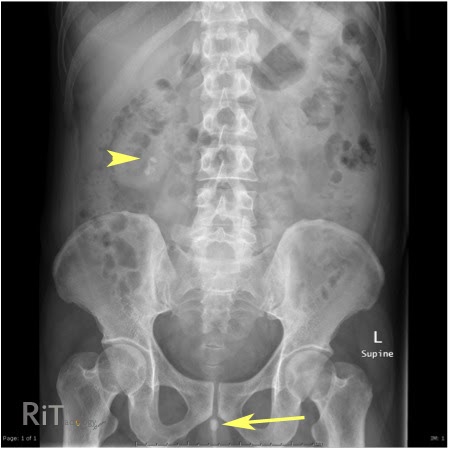 Abdominal X Ray Coffee Bean Sign Abdominal X Ray Coffee Bean Sign