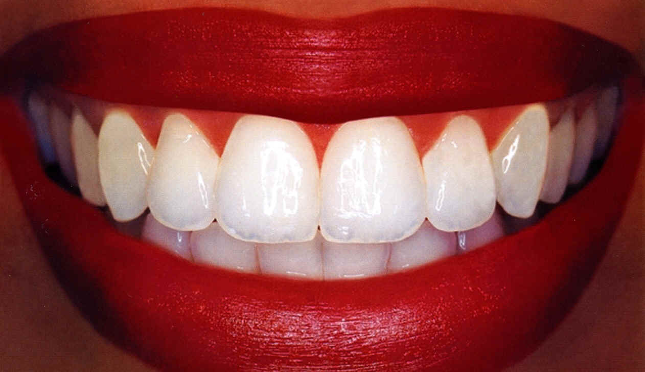Wetherby Orthodontics, Our Blog Cheap Teeth Whitening