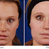 How To Get Rid Of Freckles Home Remedies