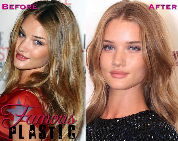 Best breast augmentation surgeon beverly hills