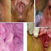 Jual Obat Sipilis Terbaik Untuk Wanita thumbnail