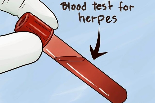 Complete Information on How to Get Tested for Genital Herpes