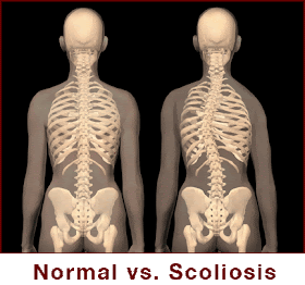 Pengertian Tentang Penyakit Scoliosis