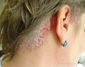 psoriasis i hårbotten psoriasis i hårbotten