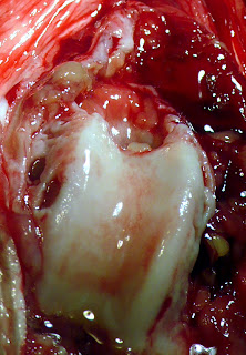 sinovitis grave proceso degenerativo articular