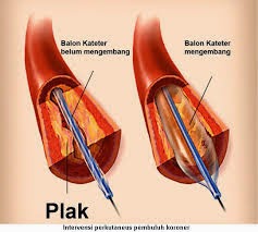 Obat Herbal Jantung Koroner