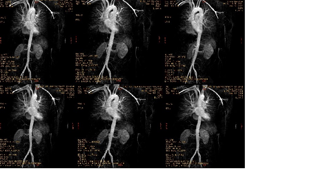 ct lower limb angio protocol