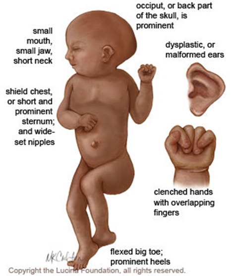 demedicina com wp content uploads edwards features thumb Ultrasound Pictures Trisomy 18,Trisomy 18 Signs,Trisomy 18 Gallery,Trisomy 18 Life Expectancy