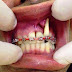 Bahaya Pakai Fake Braces Online