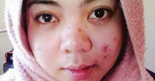 Manfaat Daun Binahong untuk jerawat