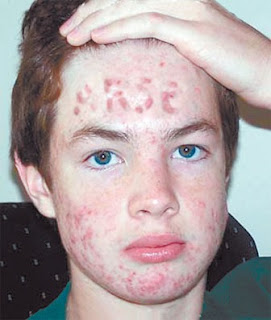 cura del acne acne no es incurable