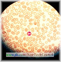 red blood cells anemia