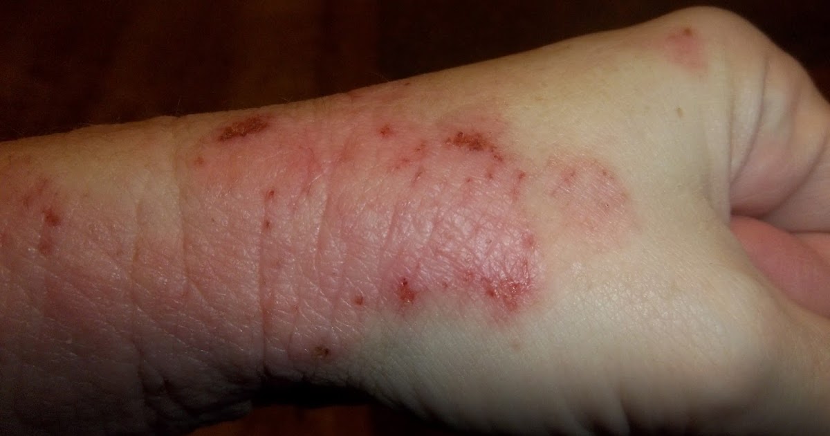 Stopping Topical Steroids Flare Pics